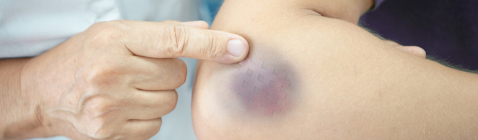 A patient with a contusion on the elbow