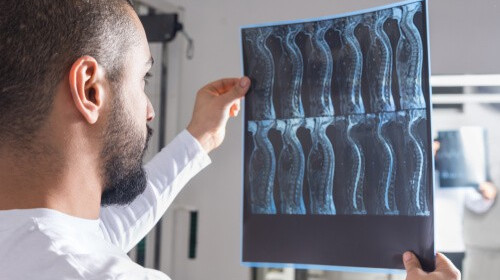 Radiologist looking at spinal cord injury x-ray